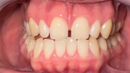 001_20240220_Ortodonzia Invisibile per Diastema Interincisivo-_11.Prima del trattamento