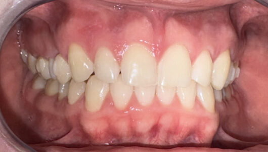 005_20241001_Ortodonzia Invisibile per Diastema Interincisivo-_55.Dopo trattamento