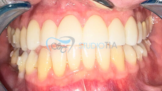 008 Dopo allineamento e applicazione di 6 corone di ceramica integrale nel settore frontale superiore