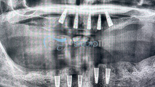 10.Controllo radiografico dopo inserimnento di impianti alle 2 arcate copia 10.Controllo radiografico dopo inserimnento di impianti alle 2 arcate copia