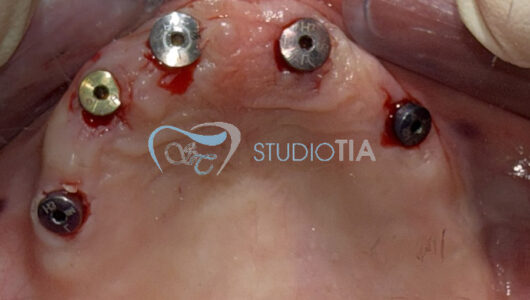 10.Seconda fase chirurgica all'arcata superiore (dopo 4 mesi dall'inserimento implantare) copia 10.Seconda fase chirurgica all'arcata superiore (dopo 4 mesi dall'inserimento implantare) copia