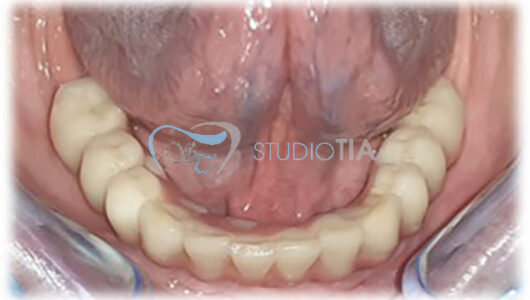 11.Consegna protesi inferiore avvitata in metallo-composito copia 11.Consegna protesi inferiore avvitata in metallo-composito copia