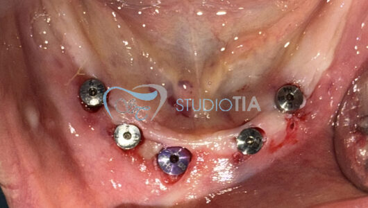 12. Seconda fase chirurgica all'arcata inferiore (a 3 mesi dall'inserimento implantare) copia 12. Seconda fase chirurgica all'arcata inferiore (a 3 mesi dall'inserimento implantare) copia