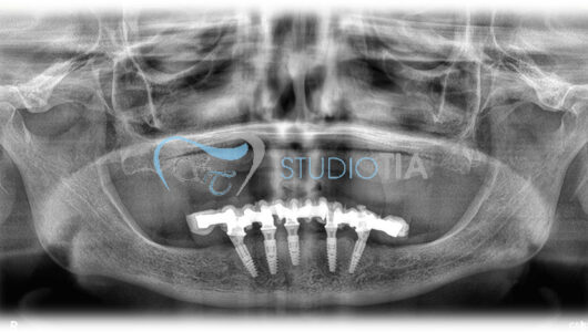 13.Controllo radiografico a 12 mesi copia 13.Controllo radiografico a 12 mesi copia