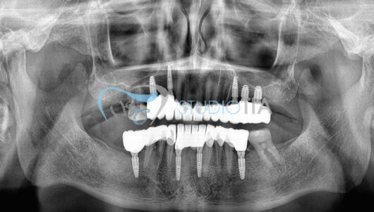 13.Controllo radiografico a 12 mesi copia 13.Controllo radiografico a 12 mesi copia
