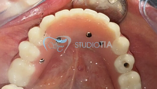15.Applicazione di protesi avvitata inferiore copia 15.Applicazione di protesi avvitata inferiore copia