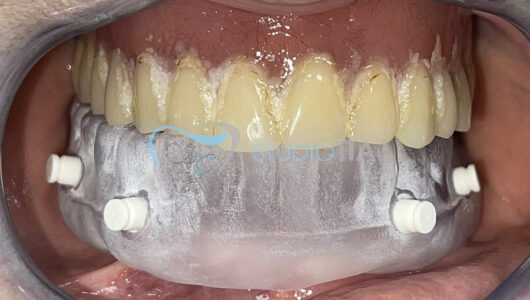 3.Preparazione di dima radiologica (scan protesi) per pianificazione implantare computer assistita copia 3.Preparazione di dima radiologica (scan protesi) per pianificazione implantare computer assistita copia