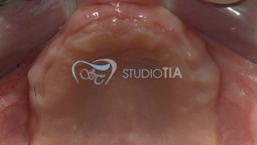 4. Guarigione dopo estrazioni dentarie superiori copia 4. Guarigione dopo estrazioni dentarie superiori copia