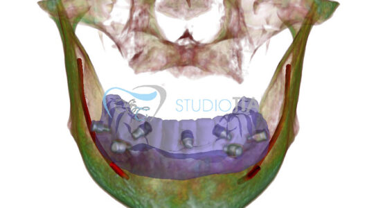 4.Pianificazione digitale per inserimento di 5 impianti inferiori copia 4.Pianificazione digitale per inserimento di 5 impianti inferiori copia