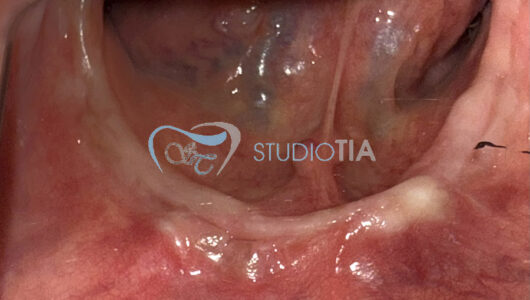 5.Guarigione dopo estrazioni dentarie inferiori copia 5.Guarigione dopo estrazioni dentarie inferiori copia