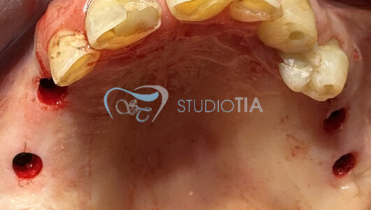 5.Immagine dopo inserimento degli impianti superiori in tecnica flapless (minimamente invasiva) copia 5.Immagine dopo inserimento degli impianti superiori in tecnica flapless (minimamente invasiva) copia