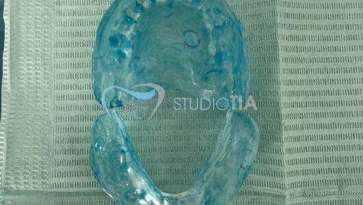 6.Dime radiologiche per preparazione delle dime chirurgiche prima della chirurgia implantare copia 6.Dime radiologiche per preparazione delle dime chirurgiche prima della chirurgia implantare copia