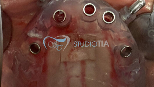 7.Applicazione dima chirurgica superiore per inserimento di 5 impianti in tecnica flapless copia 7.Applicazione dima chirurgica superiore per inserimento di 5 impianti in tecnica flapless copia