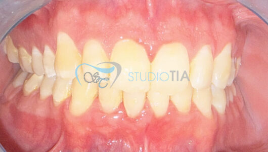 7.Dopo trattamento (risoluzione morso profondo) copia 7.Dopo trattamento (risoluzione morso profondo) copia