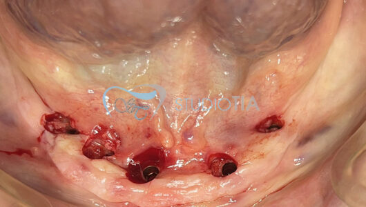 7.Foto clinica dopo inserimento di 5 impianti in chirurgia minimamente invasiva copia 7.Foto clinica dopo inserimento di 5 impianti in chirurgia minimamente invasiva copia
