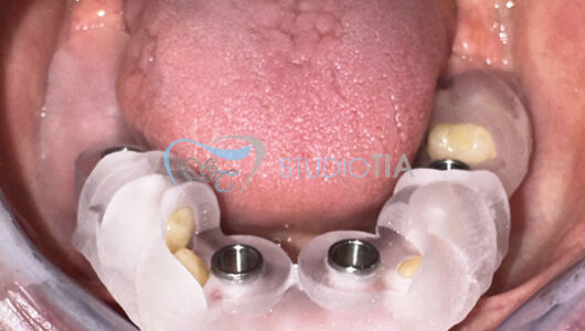 7.applicazione della dima chirurgica inferiore copia 7.applicazione della dima chirurgica inferiore copia