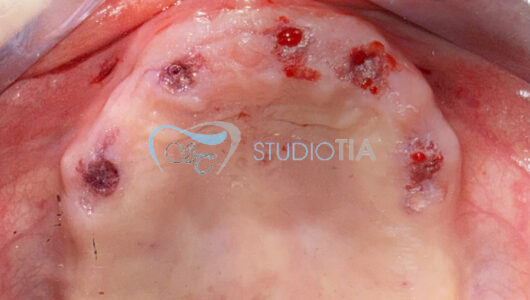 8. Immagine dopo chirurgia implantare superiore in tecnica minimamente invasiva copia 8. Immagine dopo chirurgia implantare superiore in tecnica minimamente invasiva copia