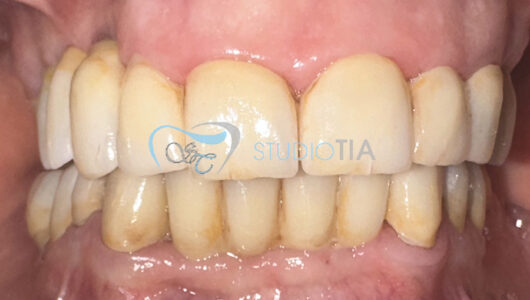8.Dopo trattamento protesico completo alle 2 arcate con corone in ceramica integrale su denti naturali e impianti copia 8.Dopo trattamento protesico completo alle 2 arcate con corone in ceramica integrale su denti naturali e impianti copia