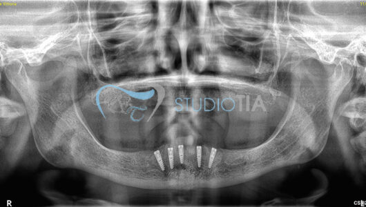 8.Radiografia di controllo dopo inserimento impianti copia 8.Radiografia di controllo dopo inserimento impianti copia