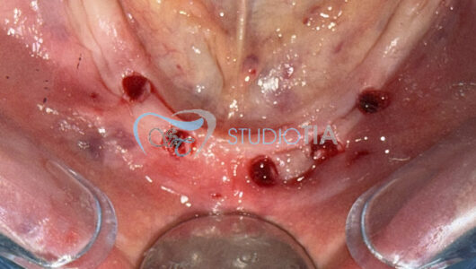 9.Immagine dopo chirurgia implantare inferiore in tecnica minimamente invasiva copia 9.Immagine dopo chirurgia implantare inferiore in tecnica minimamente invasiva copia