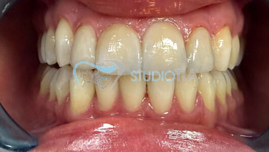 Faccette Dentali Dopo Faccette Dentali Dopo