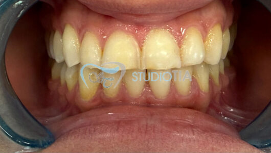 Faccette Dentali Prima Faccette Dentali Prima